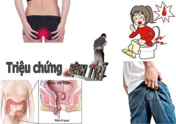 Cách trị bệnh trĩ dứt điểm của người Nhật