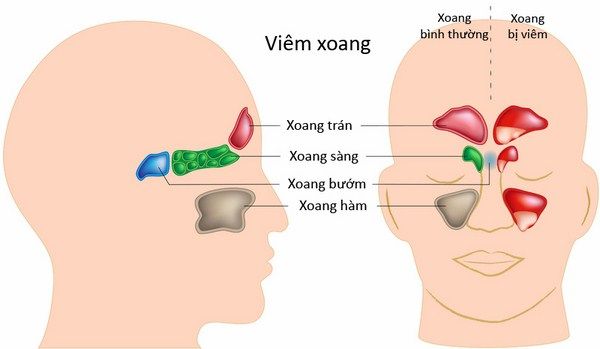 dau-hieu-va-cach-dieu-tri-viem-xoang-sang_grande Dấu hiệu và cách trị viêm xoang sàng sau