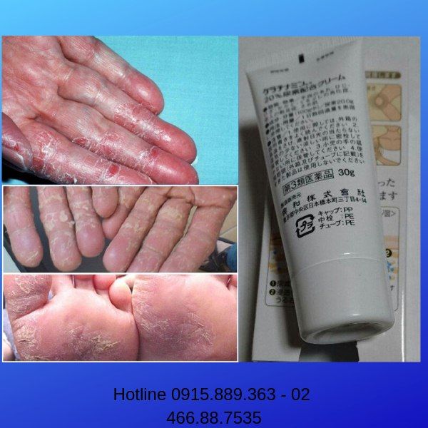 Kem trị á sừng Kowa Nhật Bản