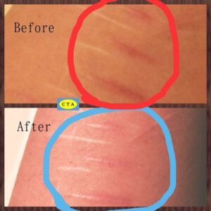 Kem trị sẹo Kobayashi Nhật Bản