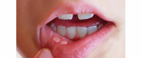 mieng_dan_tri_nhiet_mieng_taisho_30447eaa6c134ca58f02e3cbca29290e_grande mieng dan nhiet mieng