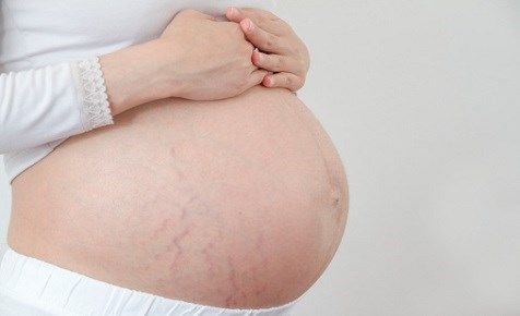 kem trị rạn da cho bà bầu