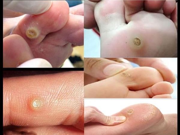Miếng dán trị mụn cóc Ibokorori Nhật Bản có thực sự tốt?