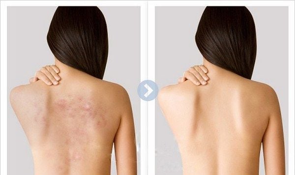 Nguyên nhân gây mụn ở lưng