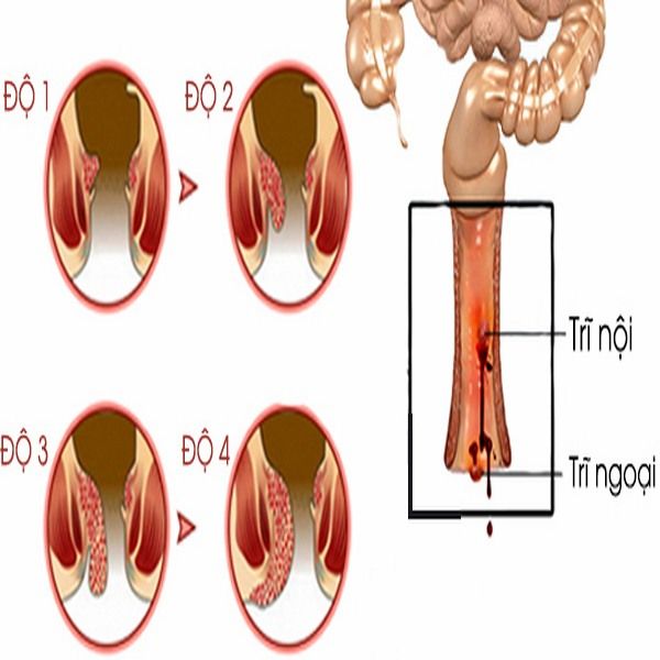 thu_c_d_t_tr__c_a_nh_t_b_n_grande Trĩ nội và trĩ ngoại loại nào nguy hiểm hơn?