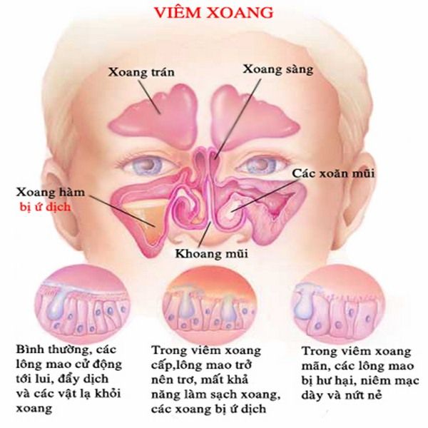 thuoc_xit_mui_tri_viem_xoang3_grande thuoc xit mui tri viem xoang