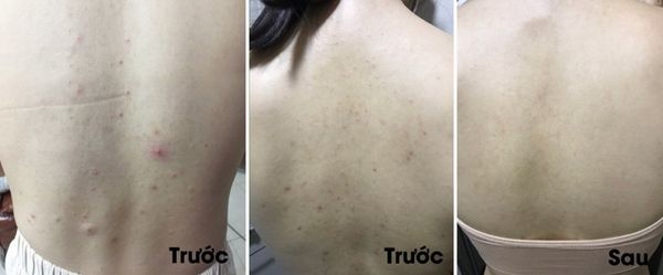tri mun lung