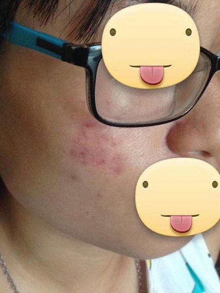 kem trị mụn