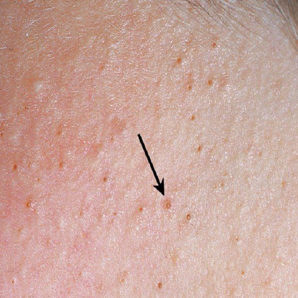 tri_viem_lo_chan_long_grande Điều trị viêm chân lông bằng những phương pháp dân gian