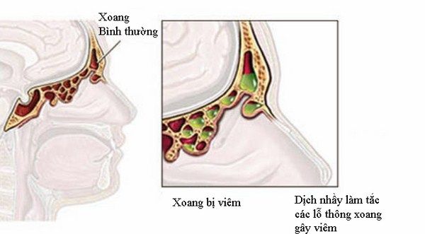 viem-xoang-sang-sau-la-gi_grande Viêm xoang sàng sau là gì