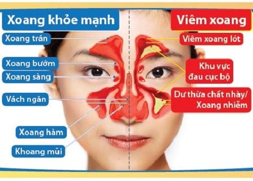 Viêm xoang trán dấu hiệu và điều trị