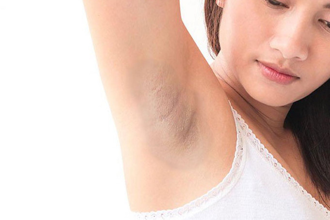Lỗ chân lông bị bít tắc là nguyên nhân khiến vùng nách bị thâm sạm