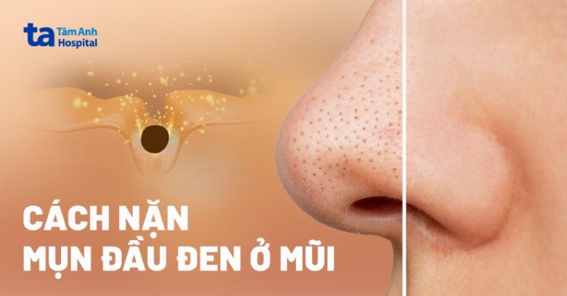 Quy trình chăm sóc da khoa học giúp loại bỏ mụn đầu đen ở mũi và làm da mịn màng hơn.