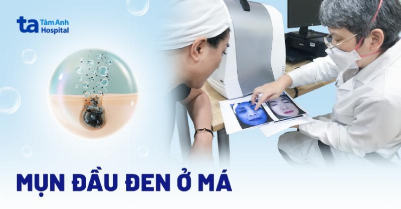 Các mẹo và lưu ý quan trọng để trị mụn đầu đen ở mũi hiệu quả, bao gồm cả chế độ sinh hoạt.
