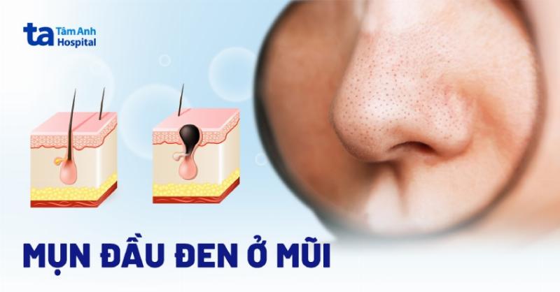 Mụn đầu đen ở mũi hình thành từ bã nhờn, tế bào chết và bụi bẩn bị oxy hóa, gây bít tắc lỗ chân lông.