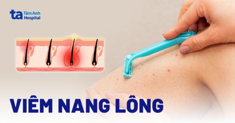 Hình ảnh minh họa các nguyên nhân phổ biến gây viêm nang lông ở chân, bao gồm dao cạo, quần áo chật, và vệ sinh kém