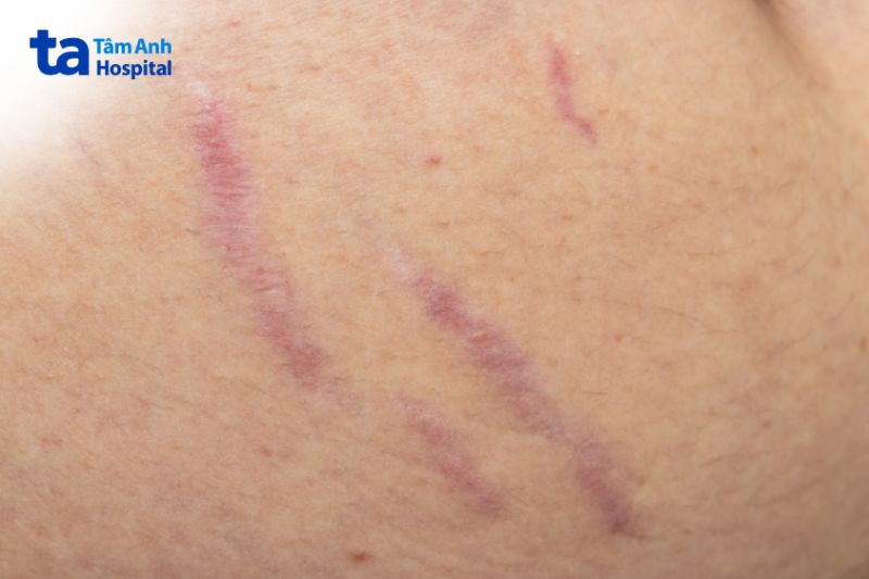 Hình ảnh vết rạn da màu đỏ