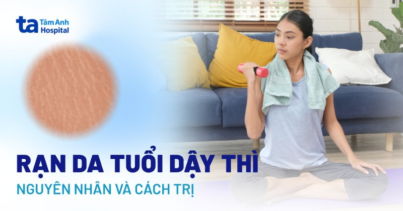 Vết rạn da ở tuổi dậy thì