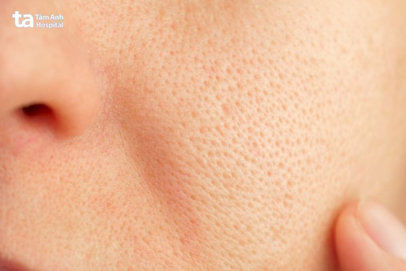 lỗ chân to làm mất thẩm mỹ