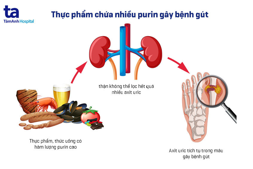 Hải sản đa dạng nhưng nhiều purin, người bị gút cần hạn chế để kiểm soát bệnh