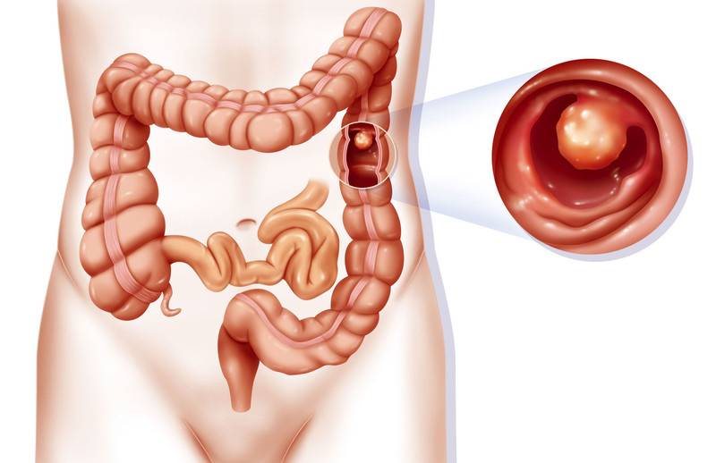 Chẩn đoán và điều trị sớm bệnh viêm đại tràng là chìa khóa để bảo vệ sức khỏe